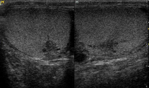 Nang tinh trùng (Spermatocele)