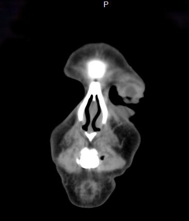 Rhabdomyosarcoma ổ mắt - Rhabdomyosarcoma (orbit)