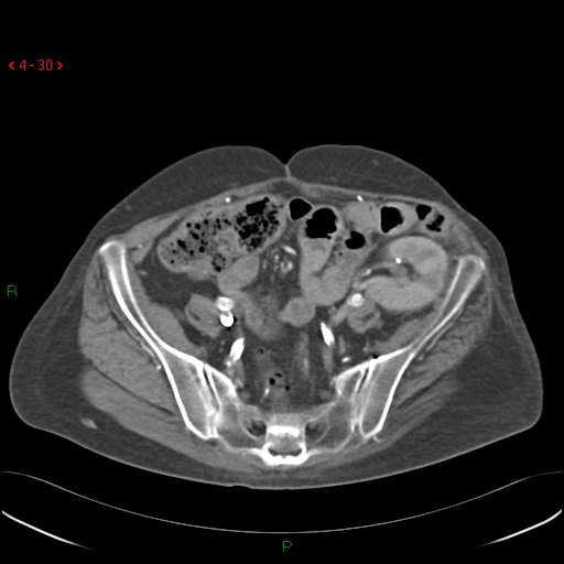 Ghép thận (Renal transplant)