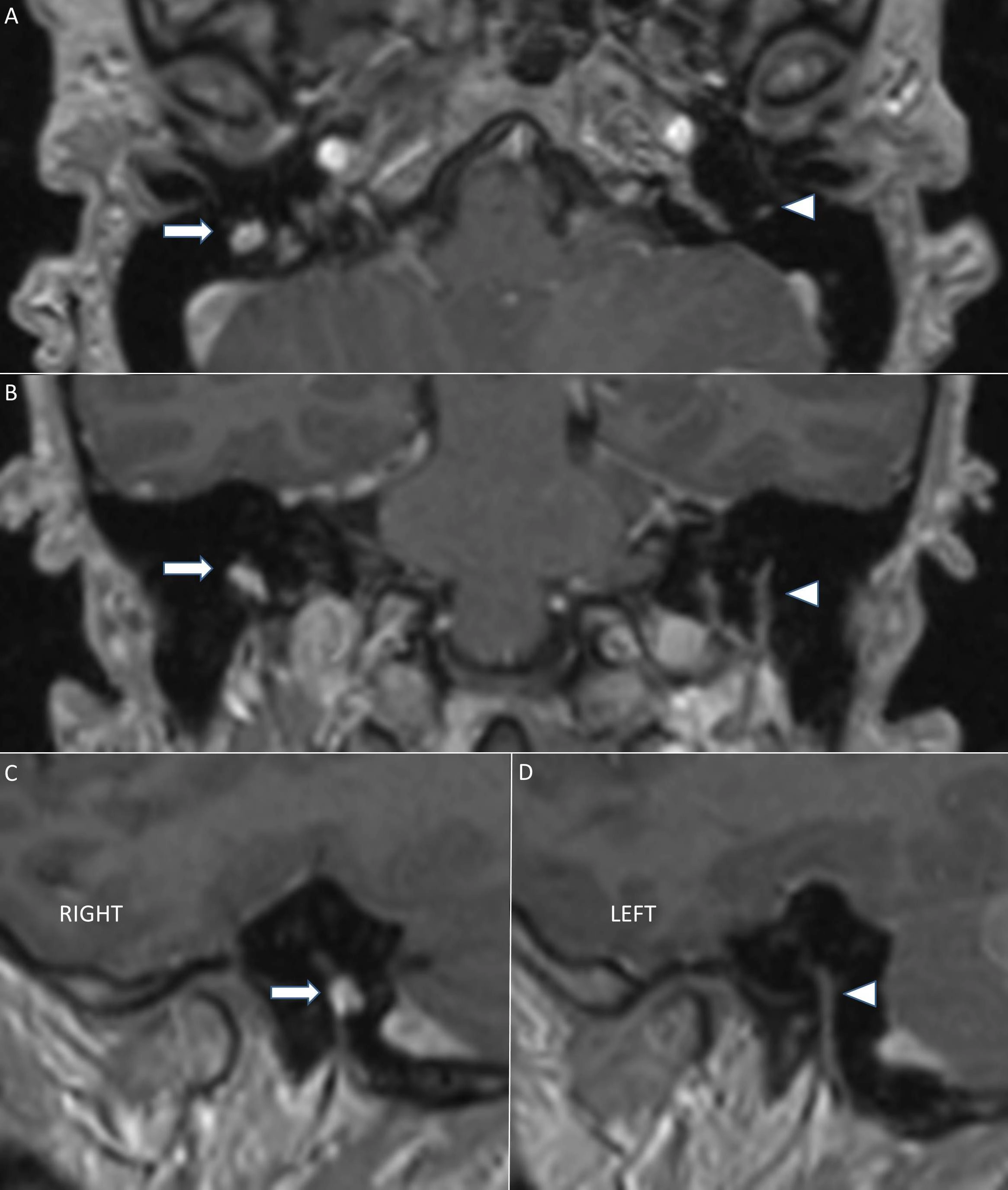 Schwannoma thần kinh mặt (Facial nerve schwannoma)