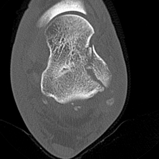 Gãy mỏm bên xương sên (Lateral talar process fracture)
