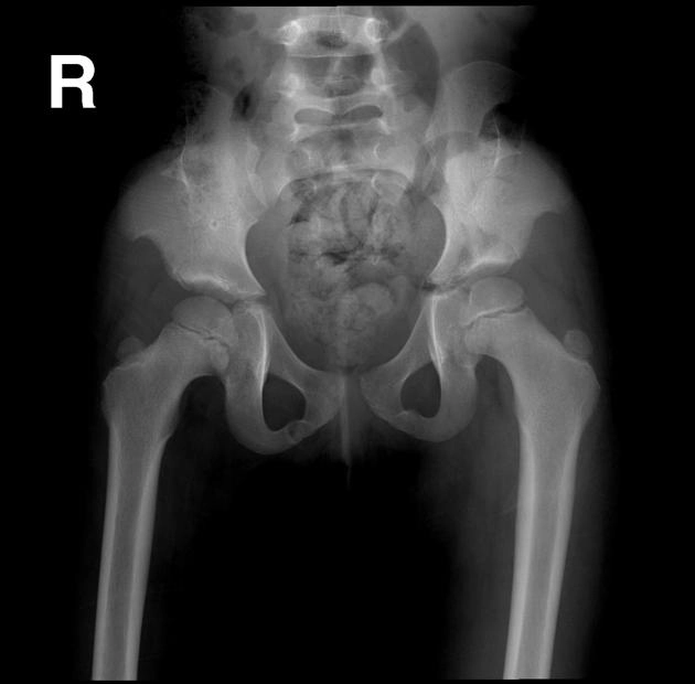 Hội chứng Móng-Xương bánh chè (Nail-patella syndrome)