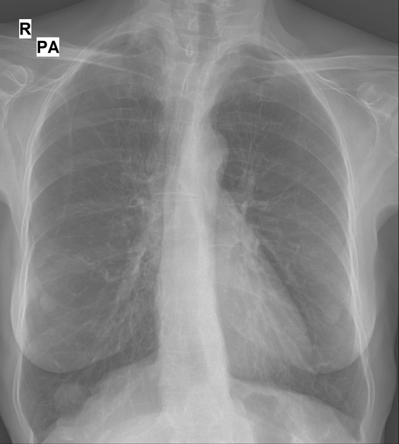 Tổn thương dạng khối ở phổi (Pulmonary Mass)