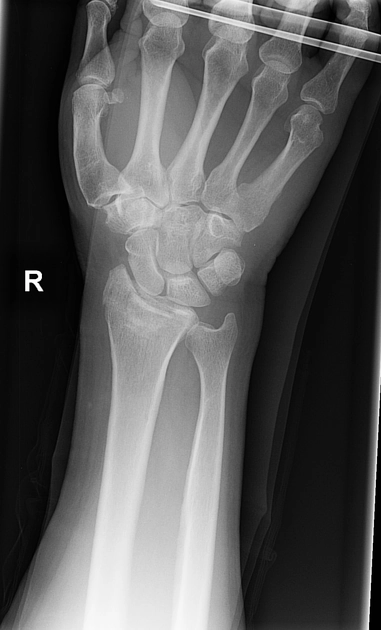 Gãy lún mặt nguyệt xương quay (Die-Punch Fracture)