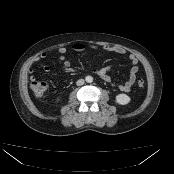 Viêm túi mật hoại tử (Gangrenous cholecystitis)