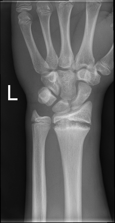Tổn thương sụn tiếp hợp do quá tải ở cổ tay trẻ em (Trauma-Related Osteolysis, Pediatric Wrist)