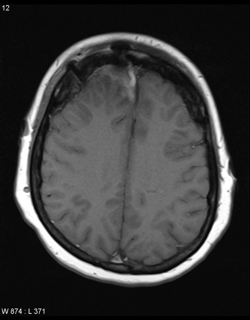 Lắng đọng Gadolinium (đối quang MRI) trong não (Gadolinium Deposition)