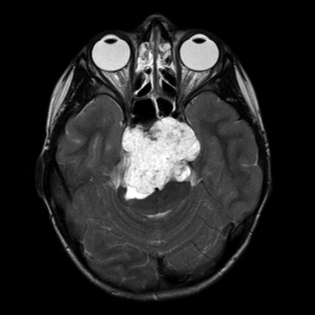Sarcoma Chordoma