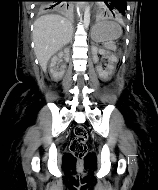 Hoại tử vỏ thận (Renal cortical necrosis)