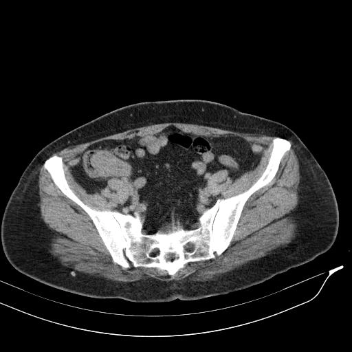 Lồng ruột thừa (Appendiceal intussusception)