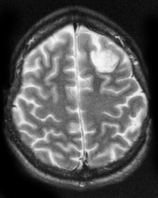 Dấu hiệu viền sáng (DNET) - Bright rim sign (DNET)