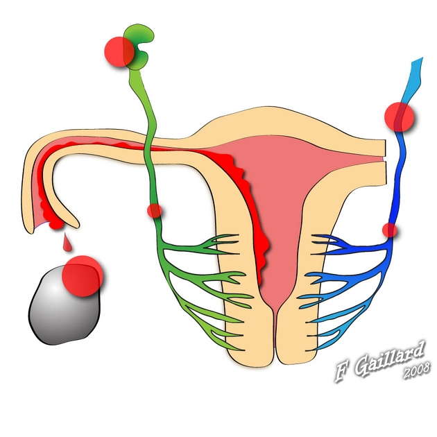 Lạc nội mạc tử cung (Endometriosis)
