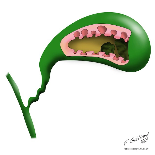 Bệnh cơ tuyến túi mật (Adenomyomatosis of the gallbladder)
