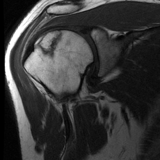Hoại tử vô mạch chỏm xương cánh tay (Osteonecrosis of the humeral head)