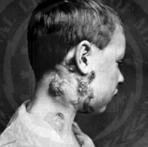 Hạch lao ở cổ (Tuberculous cervical lymphadenitis)