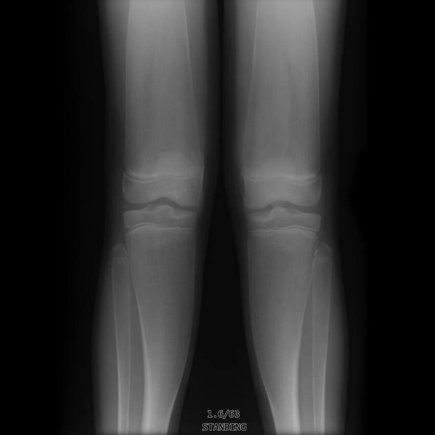  Loạn sản hành xương (Metaphyseal dysplasia)/ Bệnh Pyle