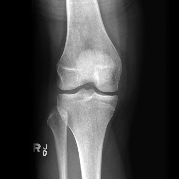Tổn thương góc sau trong (Posteromedial corner injury of the knee) 