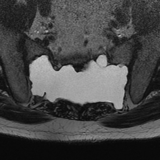 Thoát vị màng tủy xương cùng (Occult intrasacral meningocele)