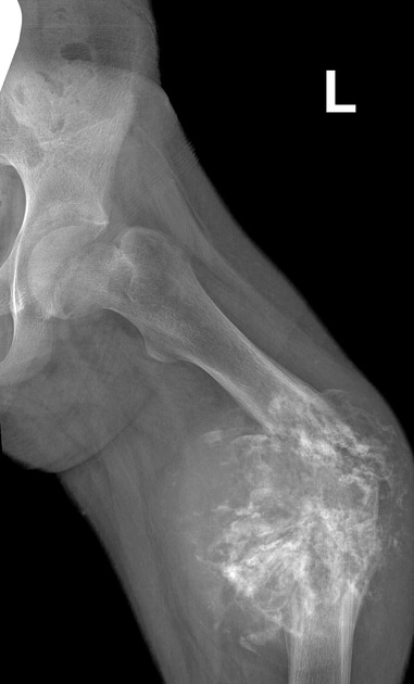 Sarcoma xương giãn mạch (Telangiectatic osteosarcoma - TOS/TAEOS) 