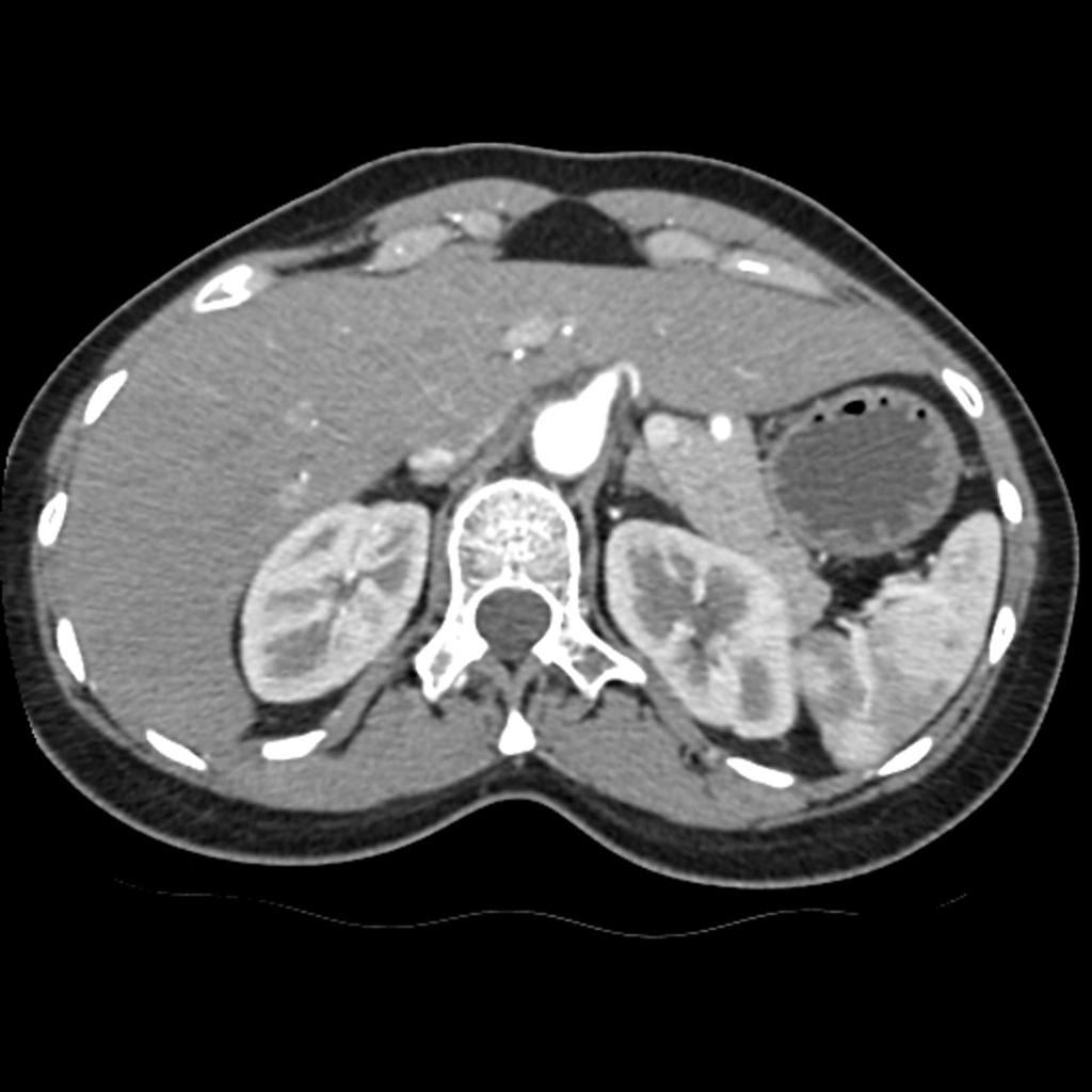 Hội chứng Kẹp hạt dẻ (Nutcracker syndrome - Tĩnh mạch thận trái bị chèn ép)