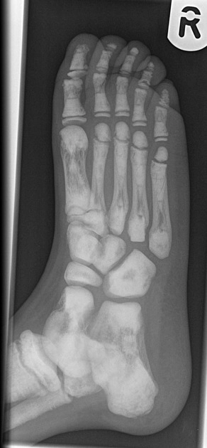 Bệnh xương hóa đá (Osteopetrosis)