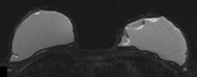 Thẩm thấu gel túi ngực (Gel bleed in breast implants)