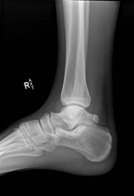 Gãy mỏm sau xương sên (Posterior talar process fracture)