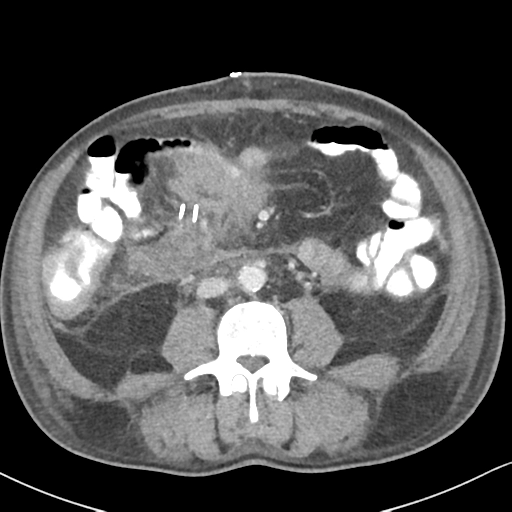 Lymphoma đại trực tràng (Large bowel lymphoma)