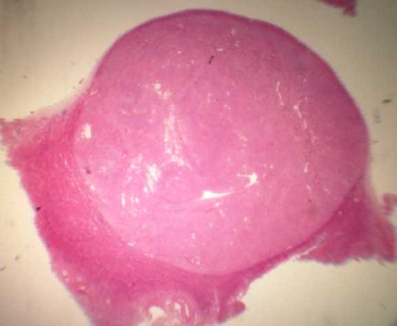 U cơ mỡ mạch thận (Renal Angiomyolipoma - AML)