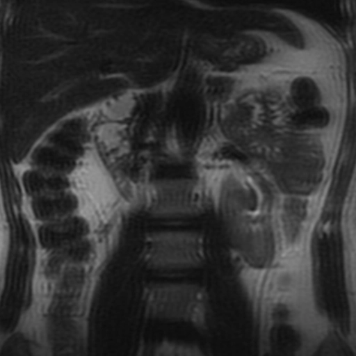 Thận xoay bất toàn (Abnormal renal rotation)