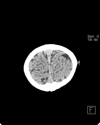 Bất sản mê nhĩ hoàn toàn (Michel aplasia)