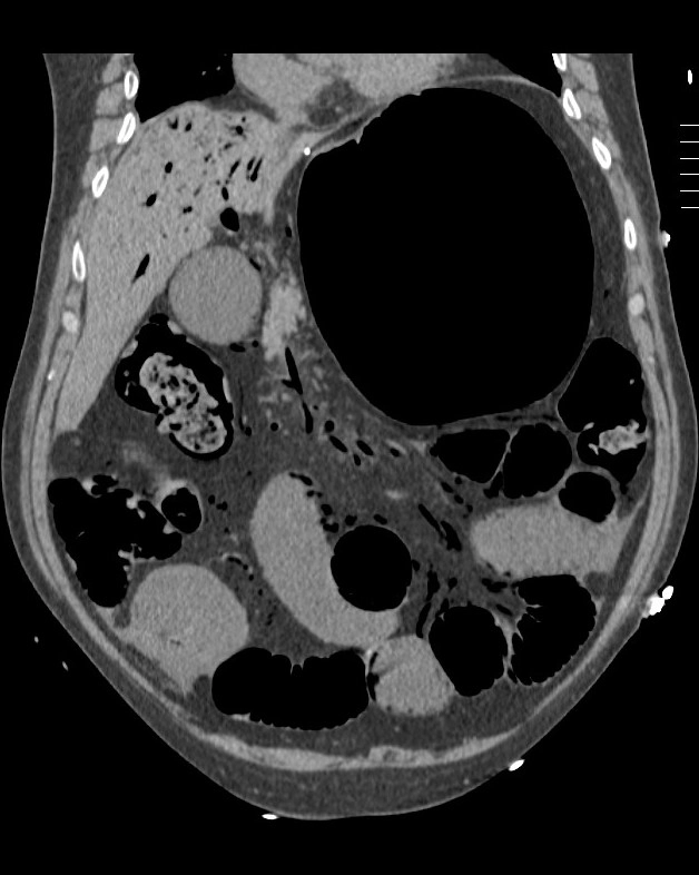 Khí trong tĩnh mạch cửa (Portal venous gas)