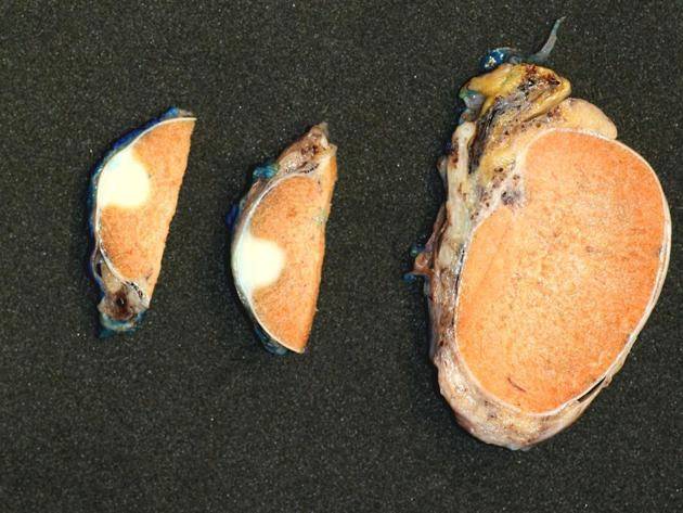 U dạng tuyến ở bìu (Adenomatoid tumors of the scrotum)