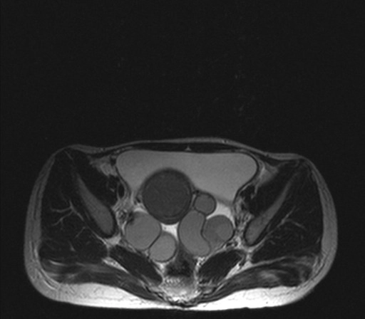 Ứ máu vòi trứng (Hematosalpinx)