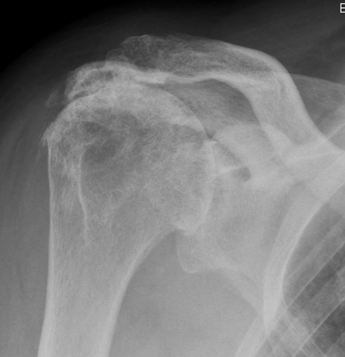 Thoái hóa khớp do Rách Chóp Xoay (Rotator Cuff Tear Arthropathy)