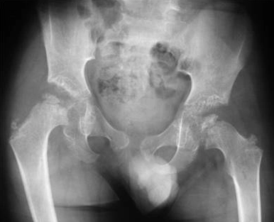Loạn sản đốt sống-đầu xương (Spondyloepiphyseal dysplasia - SED) 