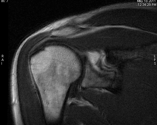 Chèn ép dưới mỏm quạ (Subcoracoid impingement)