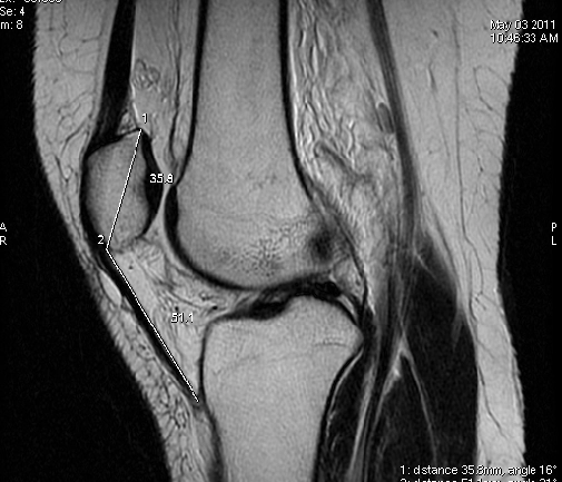 Mất vững khớp bánh chè-đùi (Patellofemoral instability)