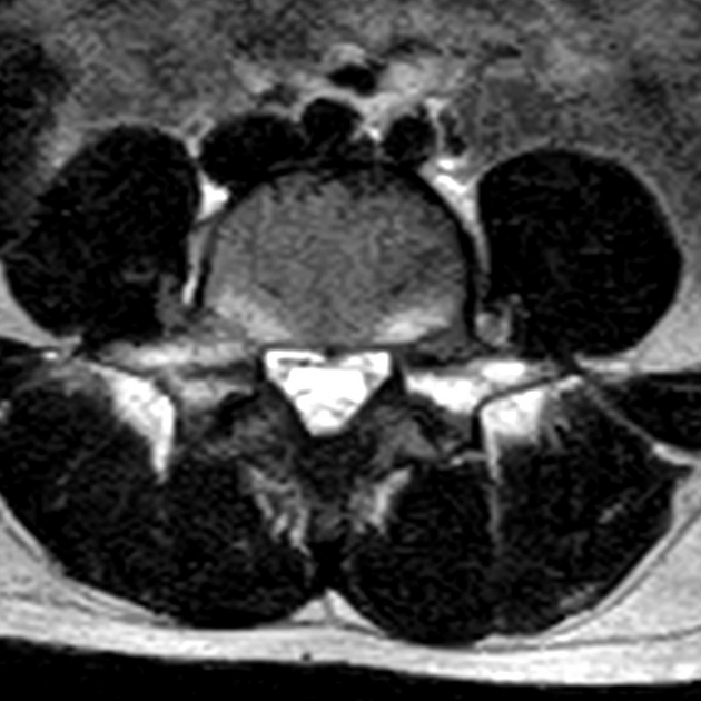 Gãy cuống sống do mỏi (Pedicle stress fracture)