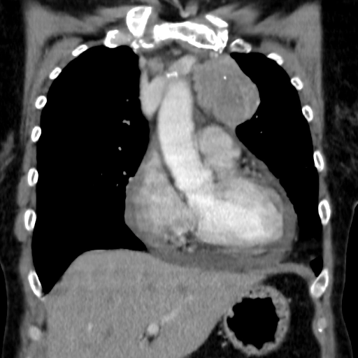 Di căn tim và màng ngoài tim (Cardiac and Pericardial Metastases)