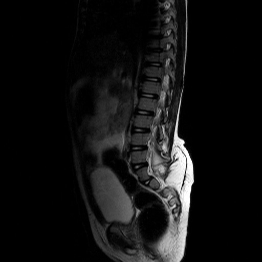 Thoát vị tủy mỡ màng tủy (Lipomyelomeningocele)