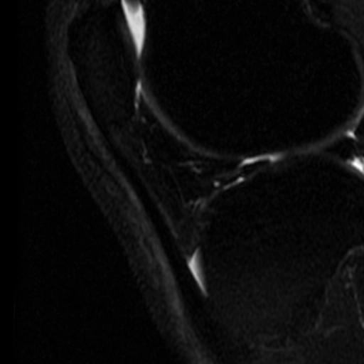 Viêm cạnh gân Achilles (Paratendinopathy)