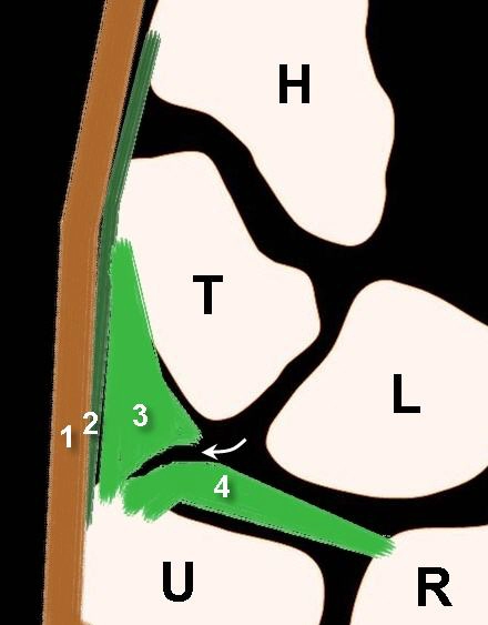 Tổn thương phức hợp sụn sợi tam giác (Triangular fibrocartilage complex - TFCC injury)