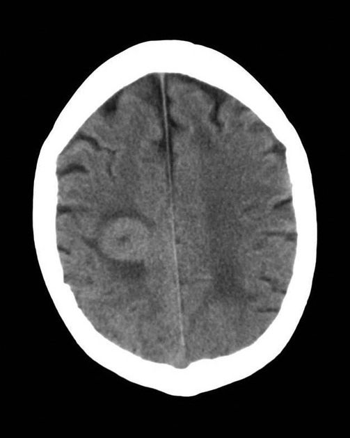 U Lympho thứ phát hệ thần kinh trung ương (Secondary CNS Lymphoma - SCNSL)
