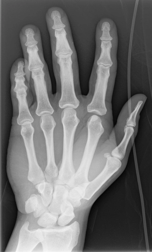 Trật khớp bàn-đốt (Metacarpophalangeal joint - MCPJ dislocation)