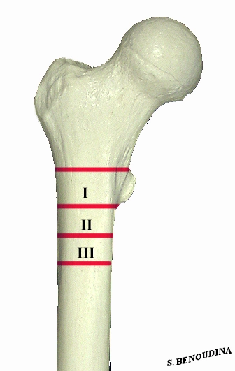 Gãy vùng mấu chuyển (Trochanteric fracture)