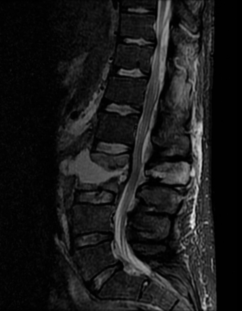 Viêm đĩa đệm đốt sống (Spondylodiscitis)