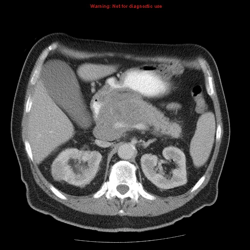 Lymphoma thận (Renal lymphoma)