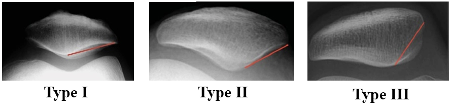  Phân loại Wiberg về hình dáng xương bánh chè