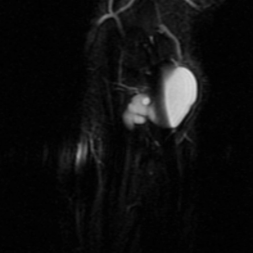 Nang bao hoạt dịch ở tay (Ganglion cysts of the hand and wrist)